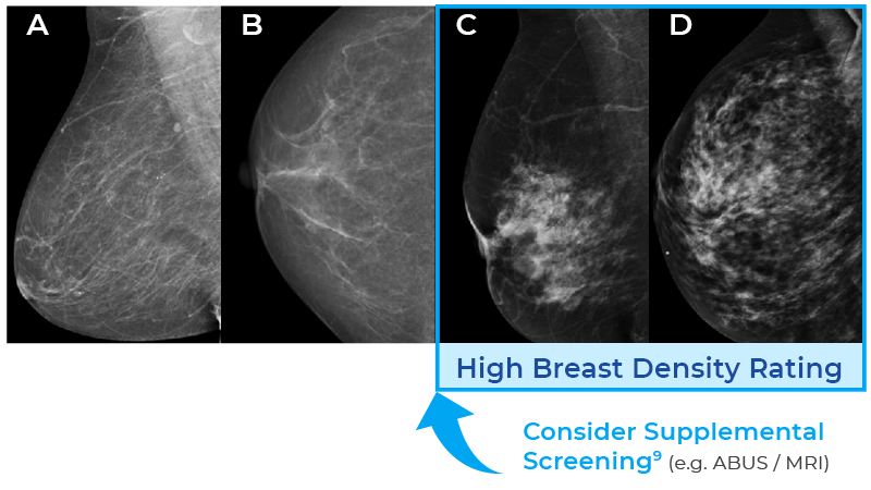 Dispersion and localized concentration of breast density